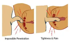 vaginismus_singapore_4.webp