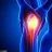 Arthritis